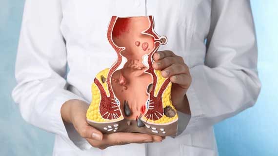 Anal Conditions